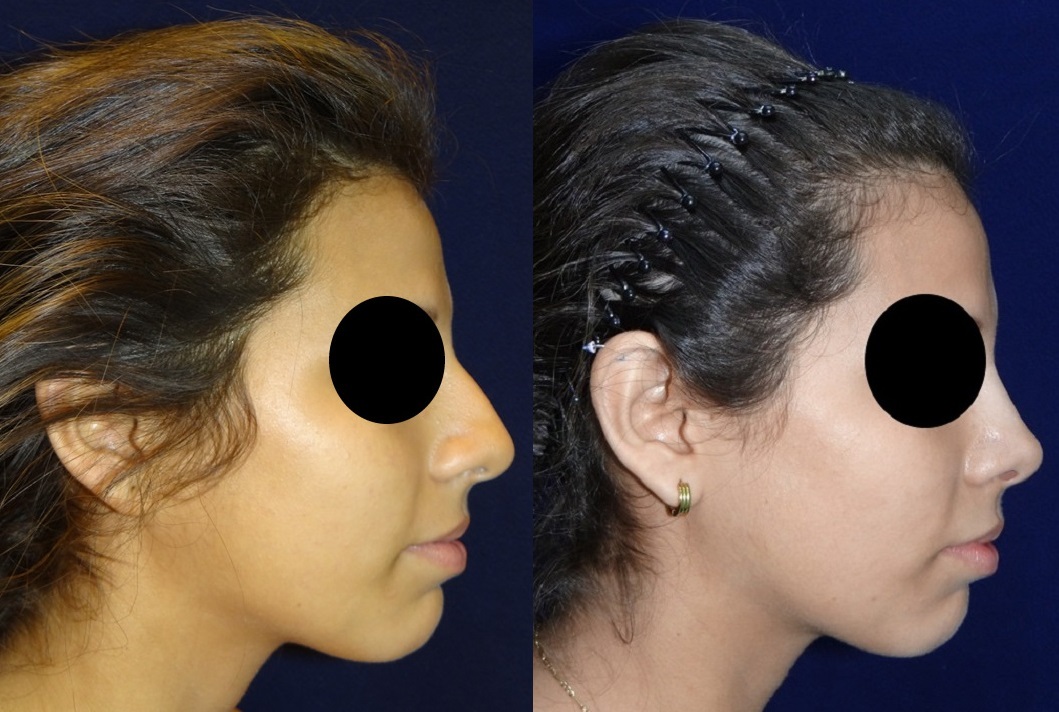 Perfiloplastia - Cirugía de Nariz con Mentón