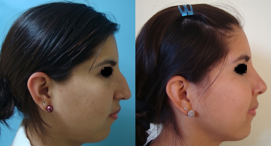 Perfiloplastia - Cirugía de Nariz con Mentón