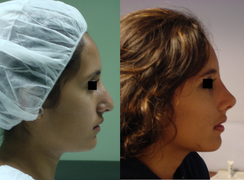 Perfiloplastia - Cirugía de Nariz con Mentón