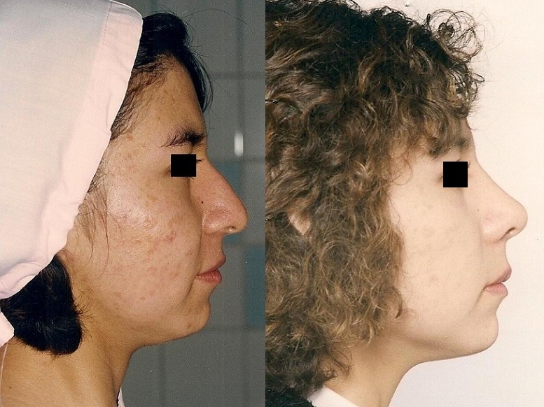 Perfiloplastia - Cirugía de Nariz con Mentón