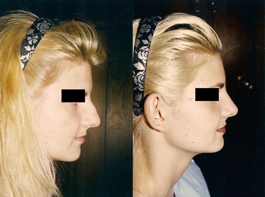 Cirugía de nariz (Rinoplastia)