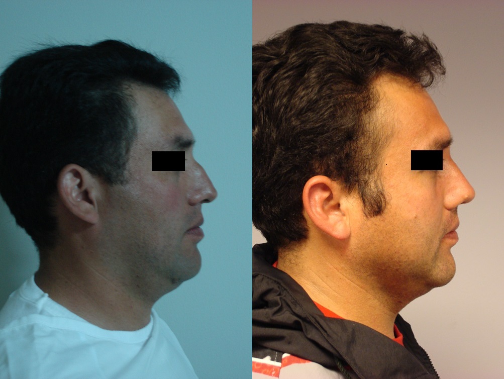 Cirugía de nariz (Rinoplastia)
