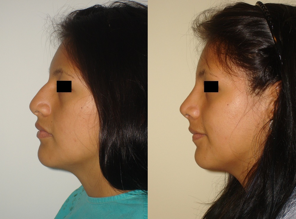 Cirugía de nariz (Rinoplastia)