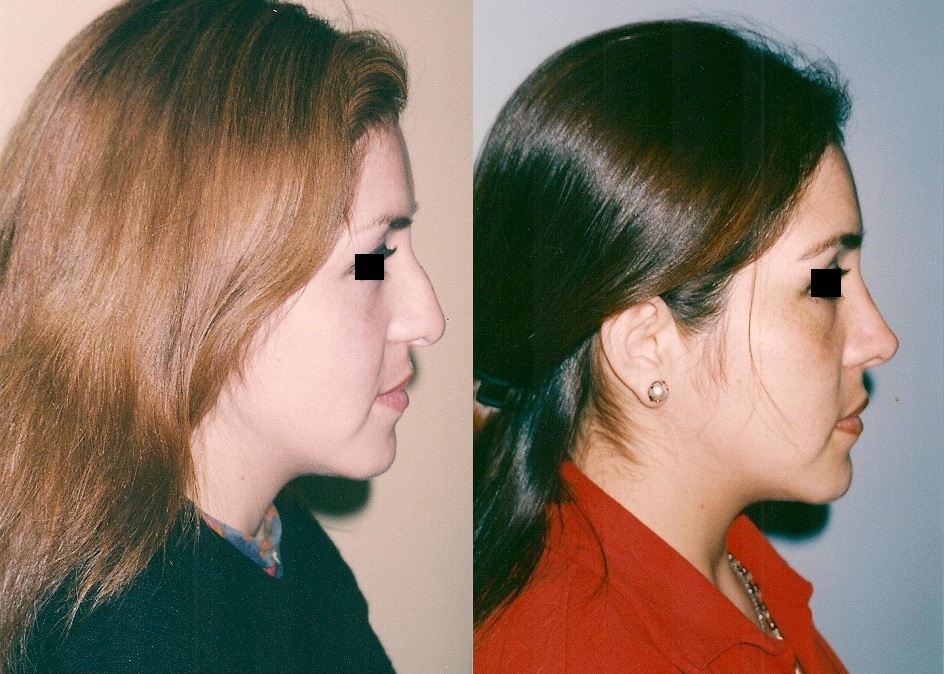 Cirugía de nariz (Rinoplastia)