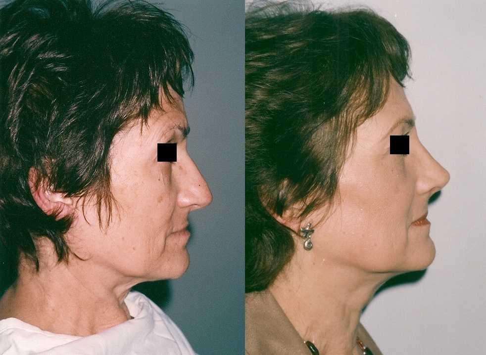 Cirugía de nariz (Rinoplastia)