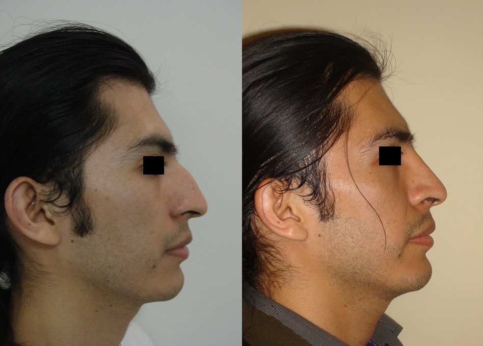 Cirugía de nariz (Rinoplastia)