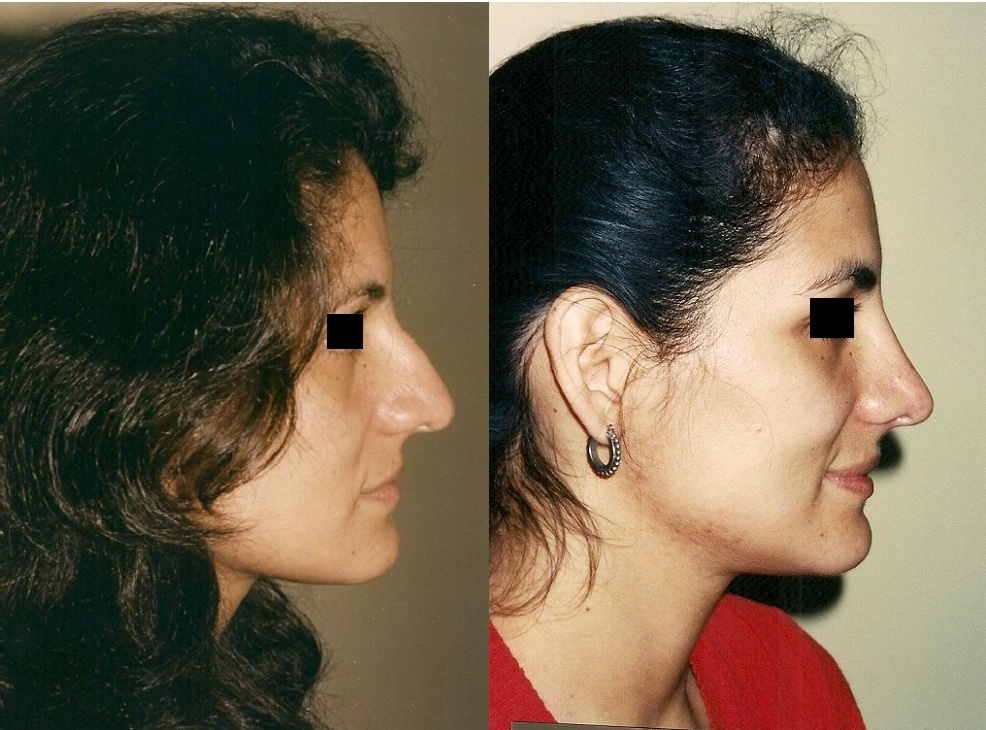 Cirugía de nariz (Rinoplastia)