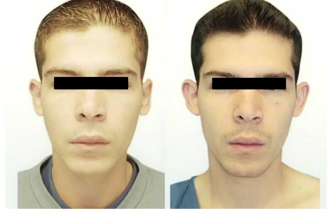 Cirugía de Orejas - Otoplastia