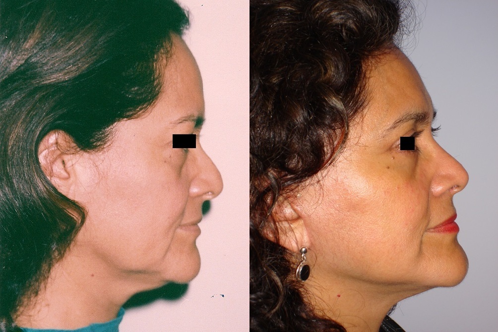 Cirugía de Párpados - Blefaroplastia