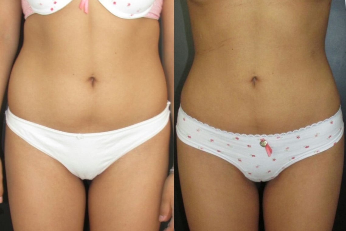 Dermolipectomía Abdominal - Abdominoplastia