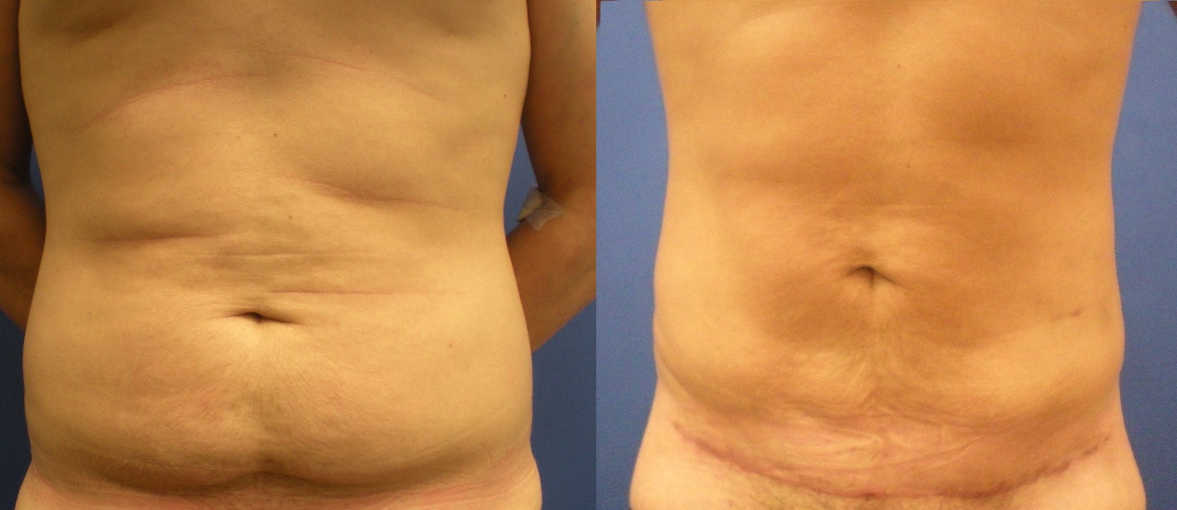 Dermolipectomía Abdominal - Abdominoplastia