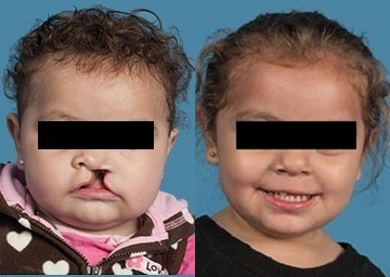 Fisura Labial Reconstructiva