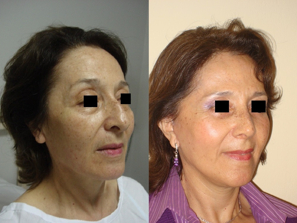 Injertos de grasa facial