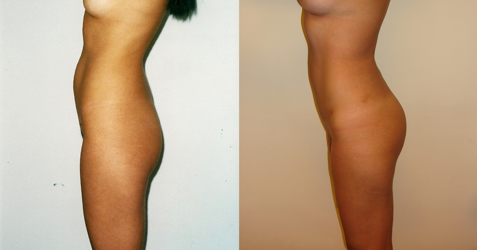 Lipoescultura y liposucción - Antes y Después