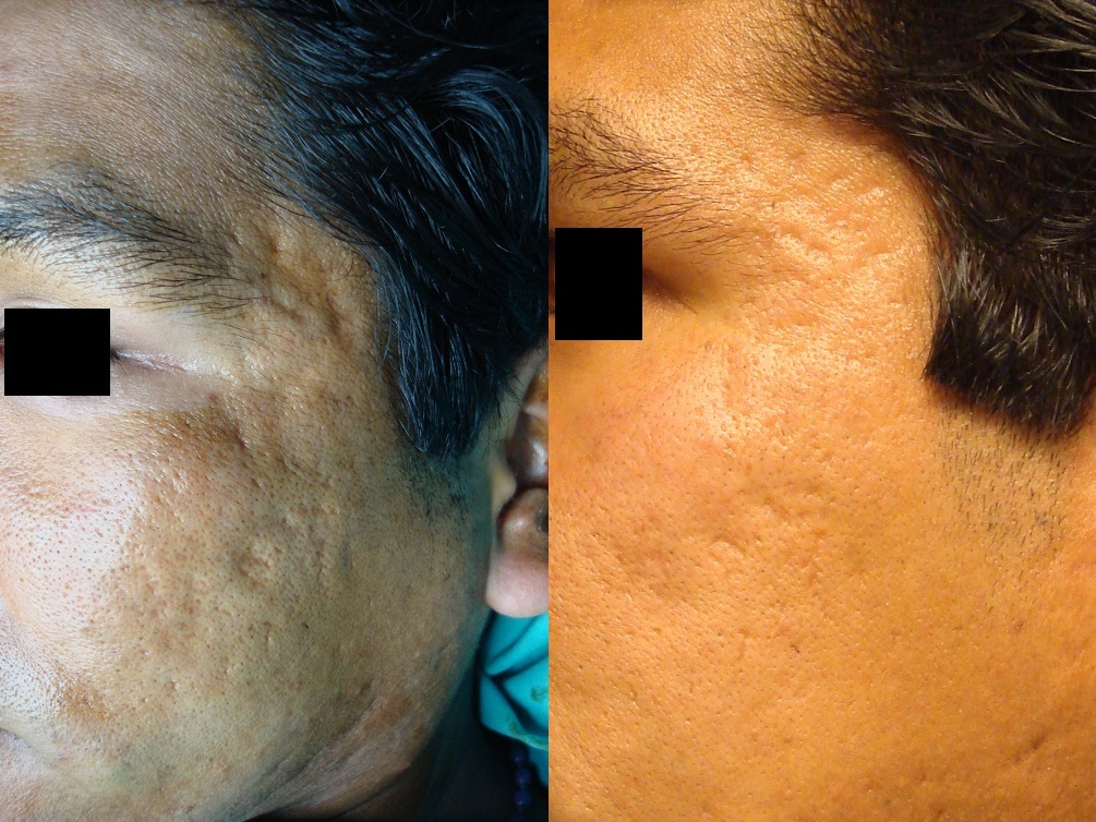 Peeling Mecánico y Dermoabrasión - Antes y Después