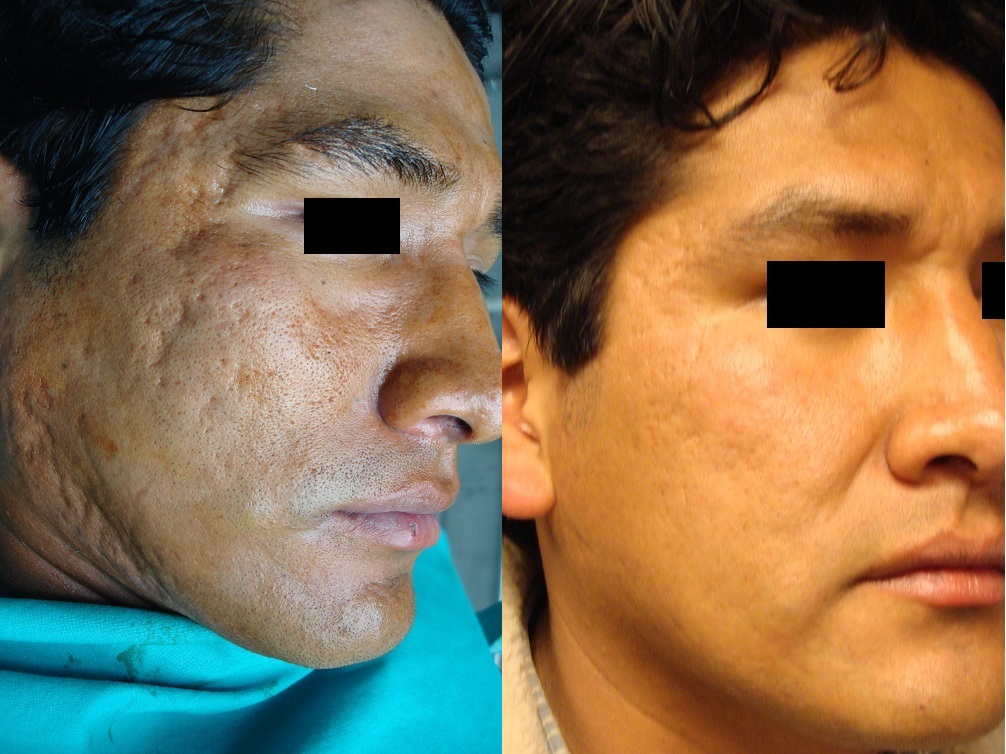 Peeling Mecánico y Dermoabrasión - Antes y Después