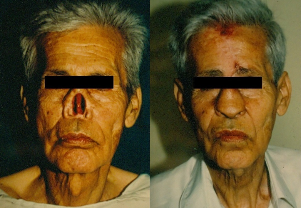 Reconstrucción Nasal Compleja - Antes y Después