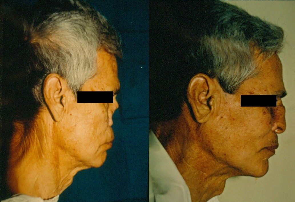 Reconstrucción Nasal Compleja - Antes y Después