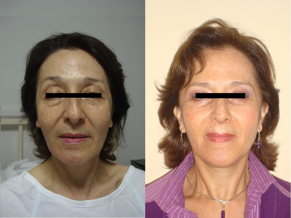 Rejuvenecimiento Facial