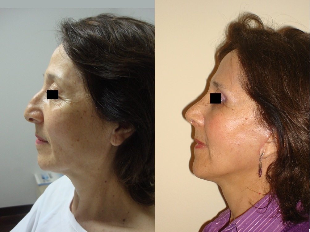 Rejuvenecimiento Facial