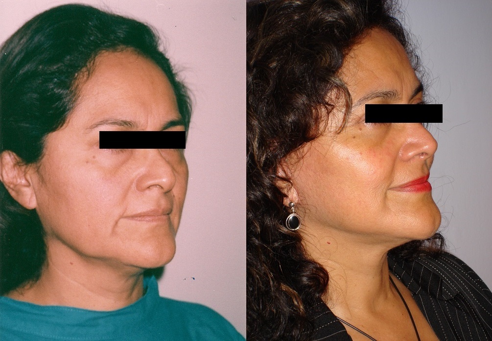 Rejuvenecimiento Facial
