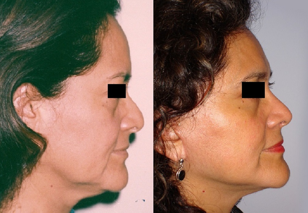 Rejuvenecimiento Facial