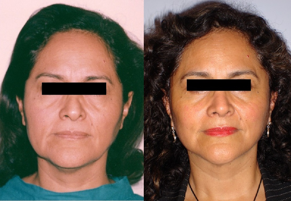 Rejuvenecimiento Facial